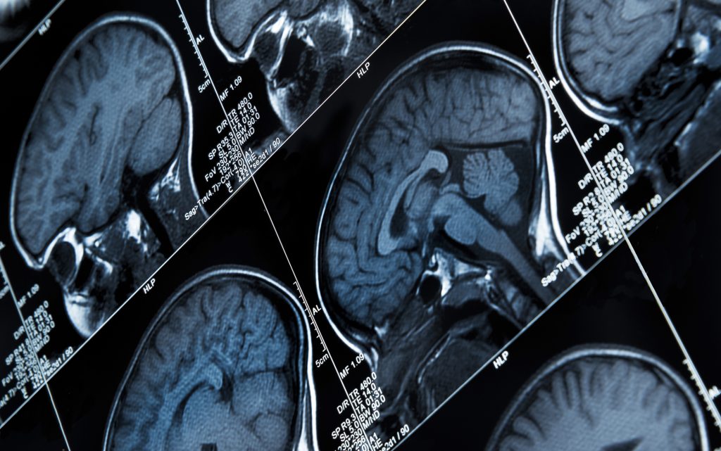 MRI Brain Scan results of heads and skulls